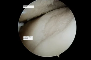 type de astroscope sur l'articulation du genou avec de l'arthrose de la 3ème degré