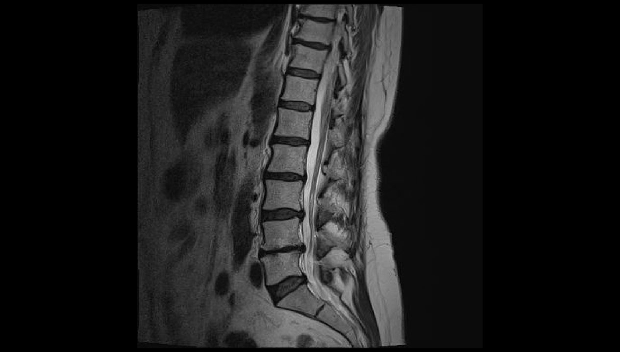 Diagnostiquer les maux de dos dans la région lombaire