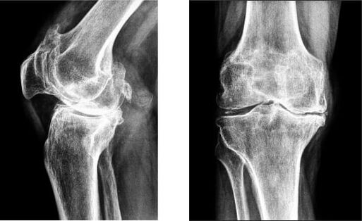 Radiographie de la gonarthrose du genou