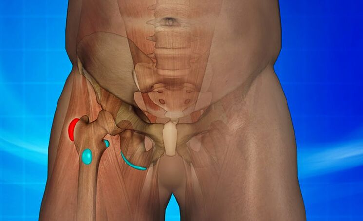 Inflammation de l'articulation de la hanche comme cause de la douleur