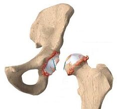 Causes de l'arthrose de l'articulation de la hanche