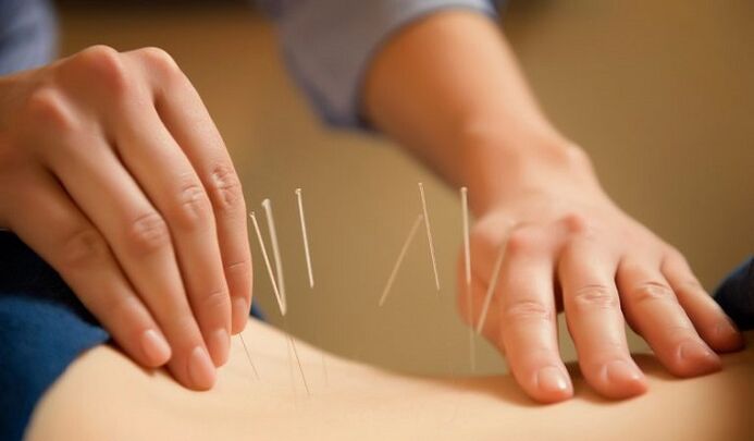 L'acupuncture utilisée pour traiter les maux de dos