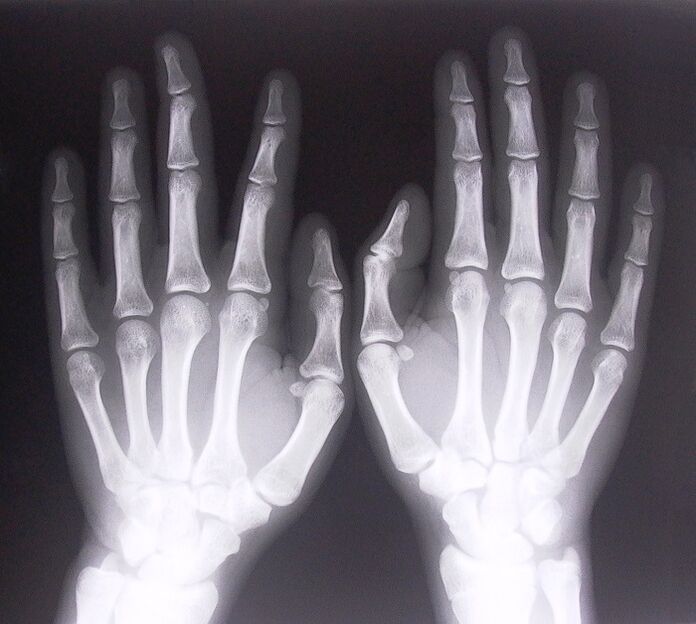 Radiographie utilisée pour diagnostiquer la douleur dans les articulations des doigts