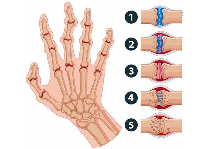 Stades de développement de l'arthrite des articulations des doigts